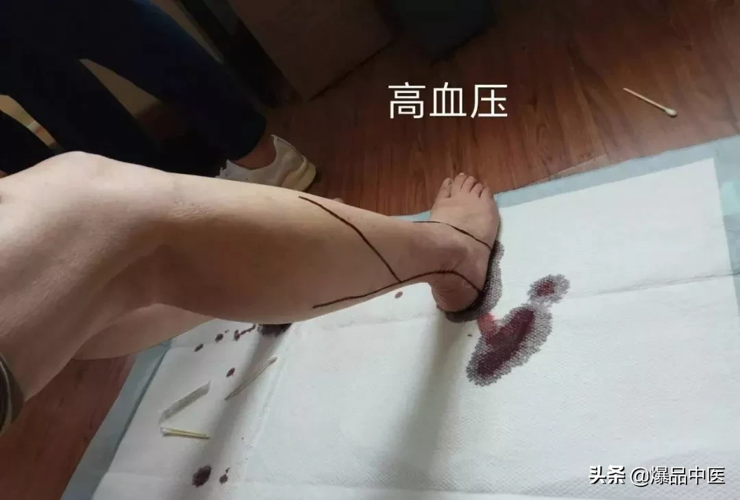 刺络放血,大病小病都不怕