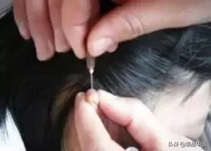 刺络放血,大病小病都不怕