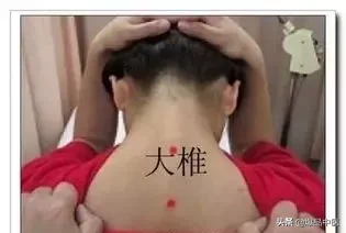 刺络放血,大病小病都不怕