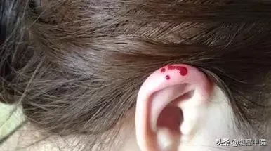 刺络放血,大病小病都不怕