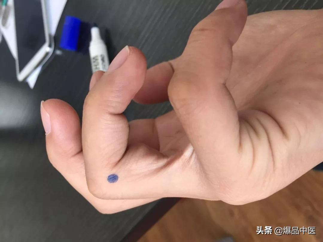 手上有四个穴位,可治疗一切头疼