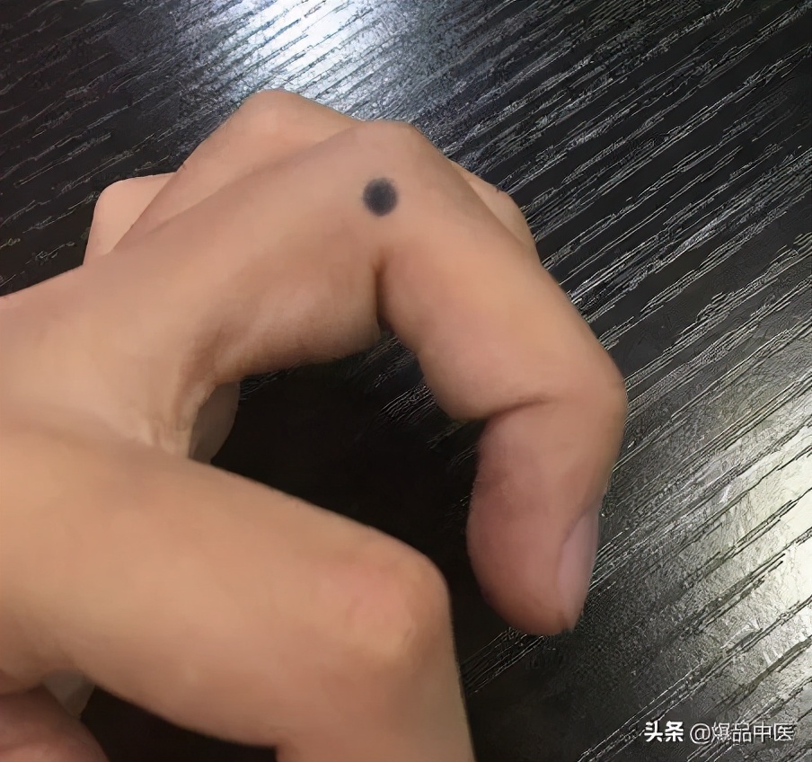 手上有四个穴位,可治疗一切头疼