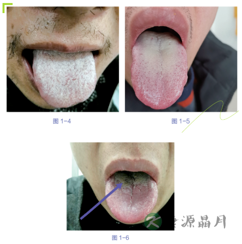 舌诊裂纹.png