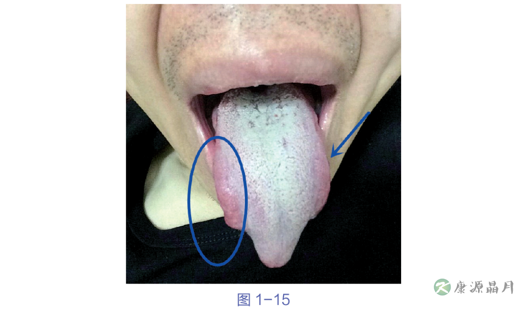 舌苔极其不干净.png