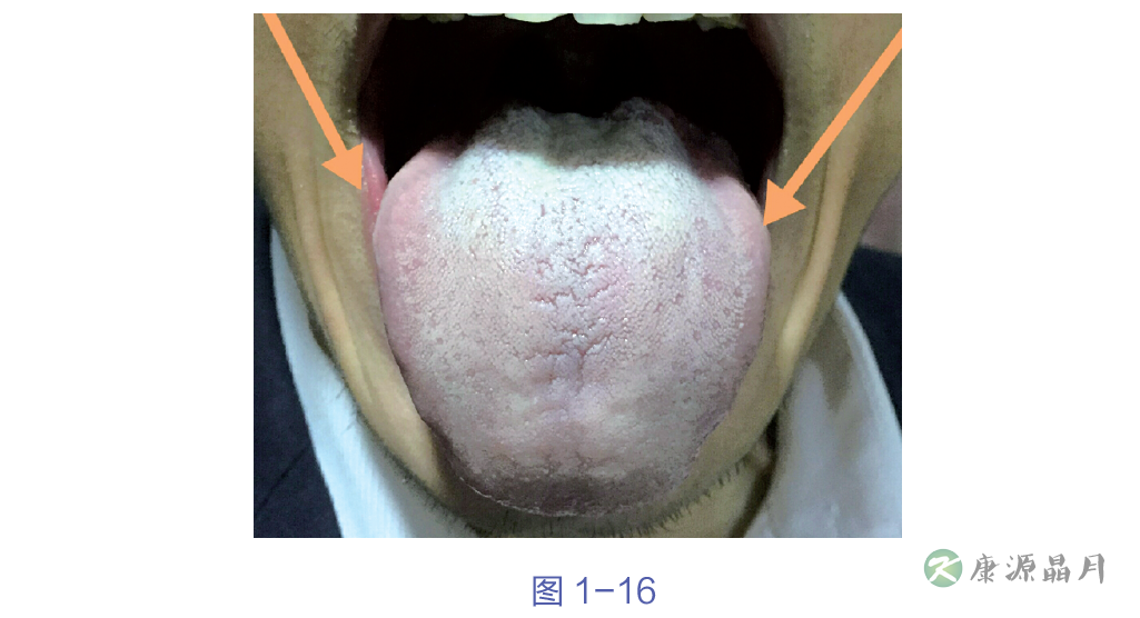 舌两边突出明显.png