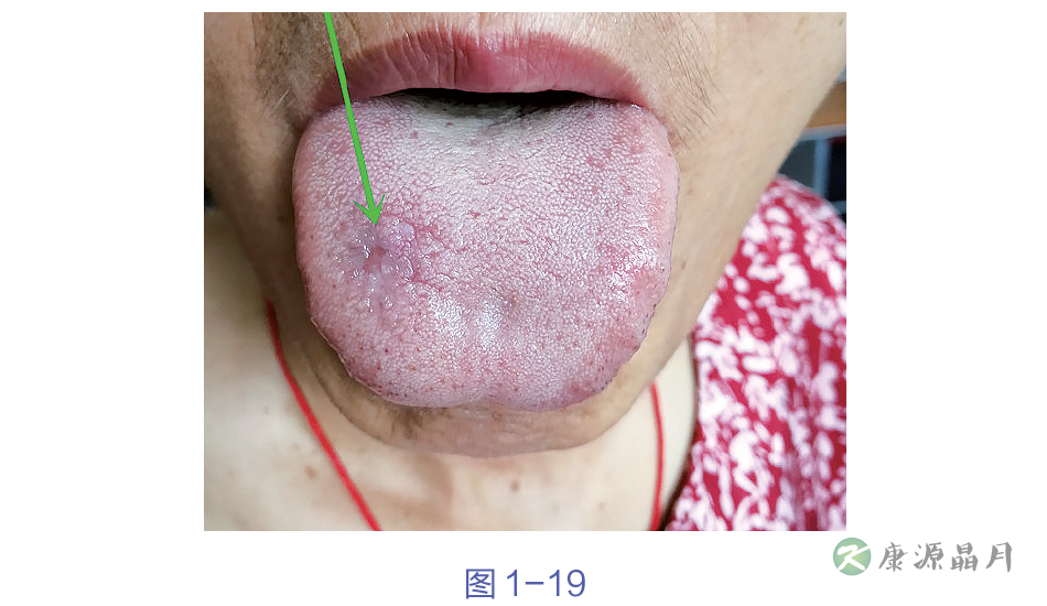舌癣.png
