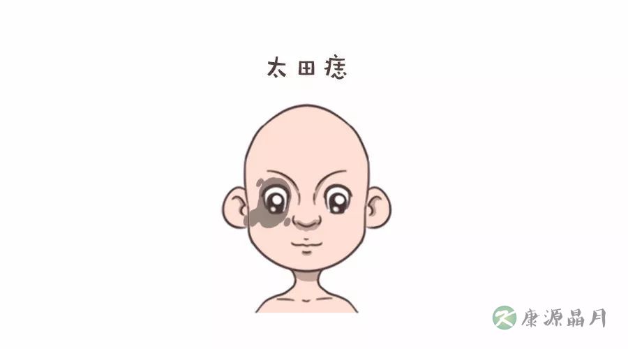 太田痣.jpg