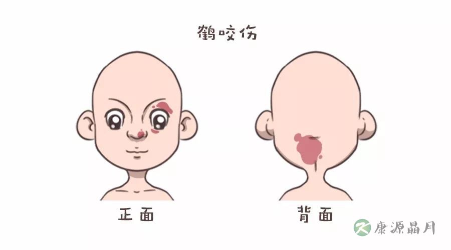 鹤咬伤.jpg