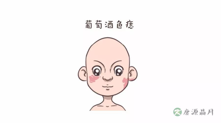 葡萄酒色痣.jpg