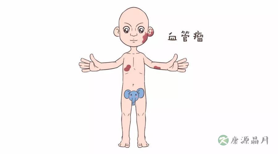血管瘤.jpg