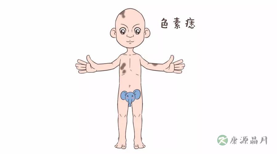色素痣.jpg
