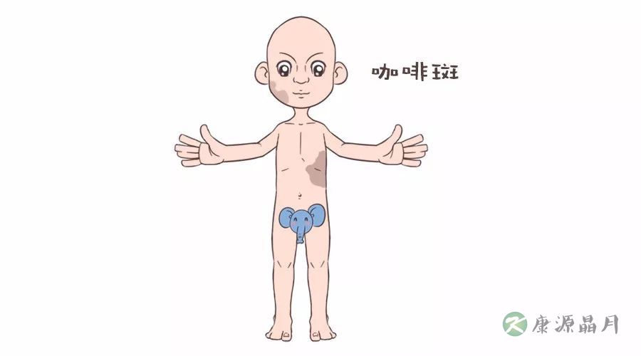 咖啡斑.jpg