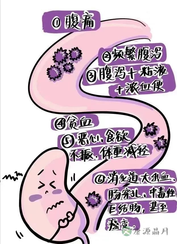 炎症性肠病.jpg