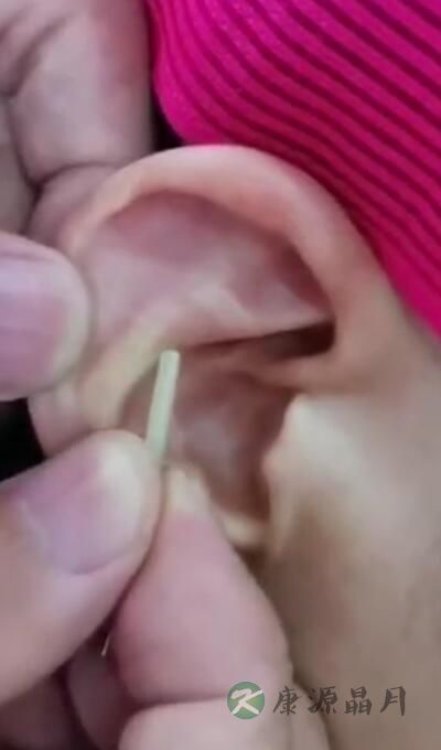足跟痛操作要点