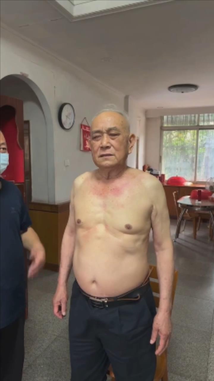 八十岁老人多年被西医+许多中医诊断肺气肿、肺心病